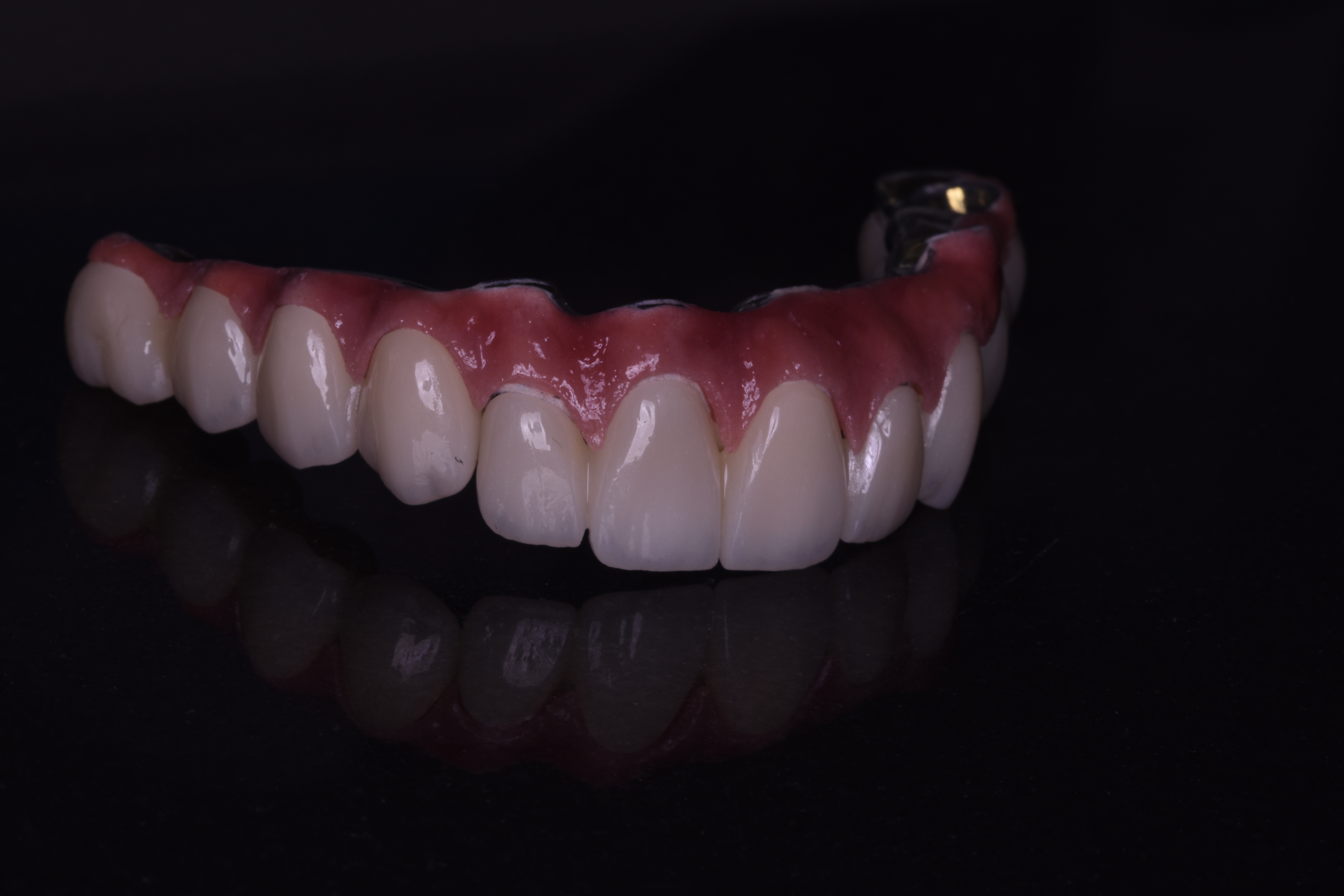 Hybrid Prosthesis