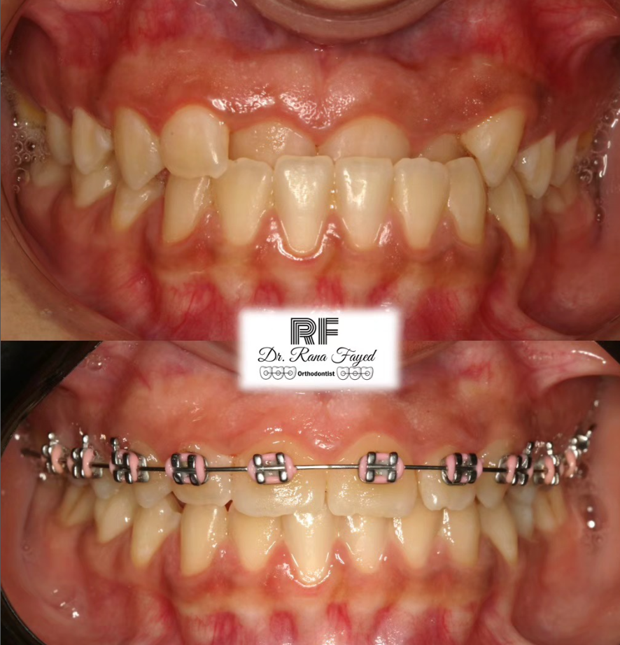 Orthodontics Before & After
