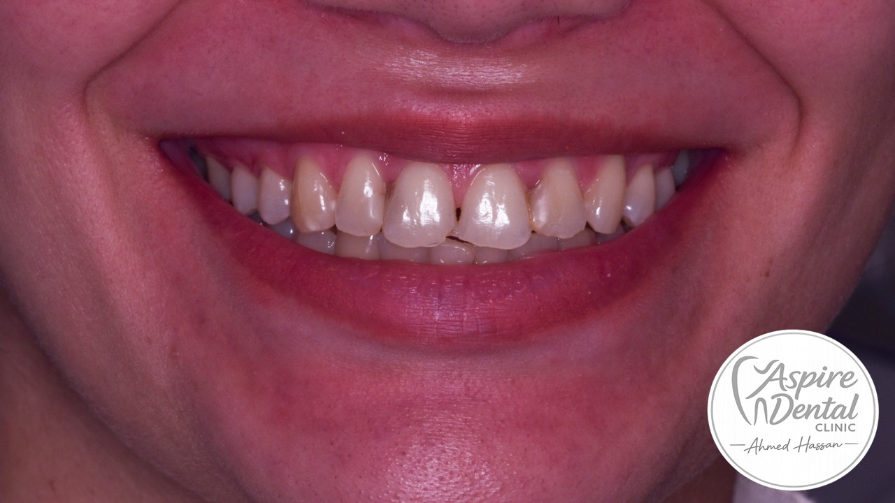 Before