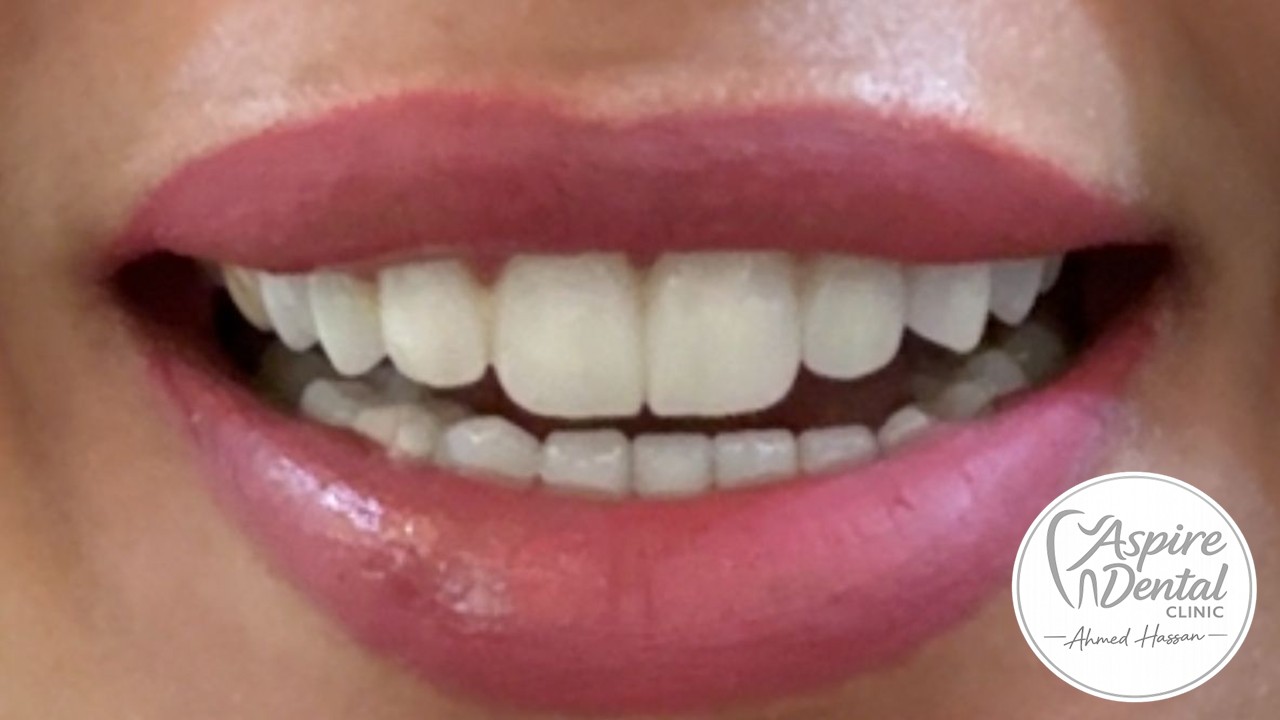 Smile Makeover Case