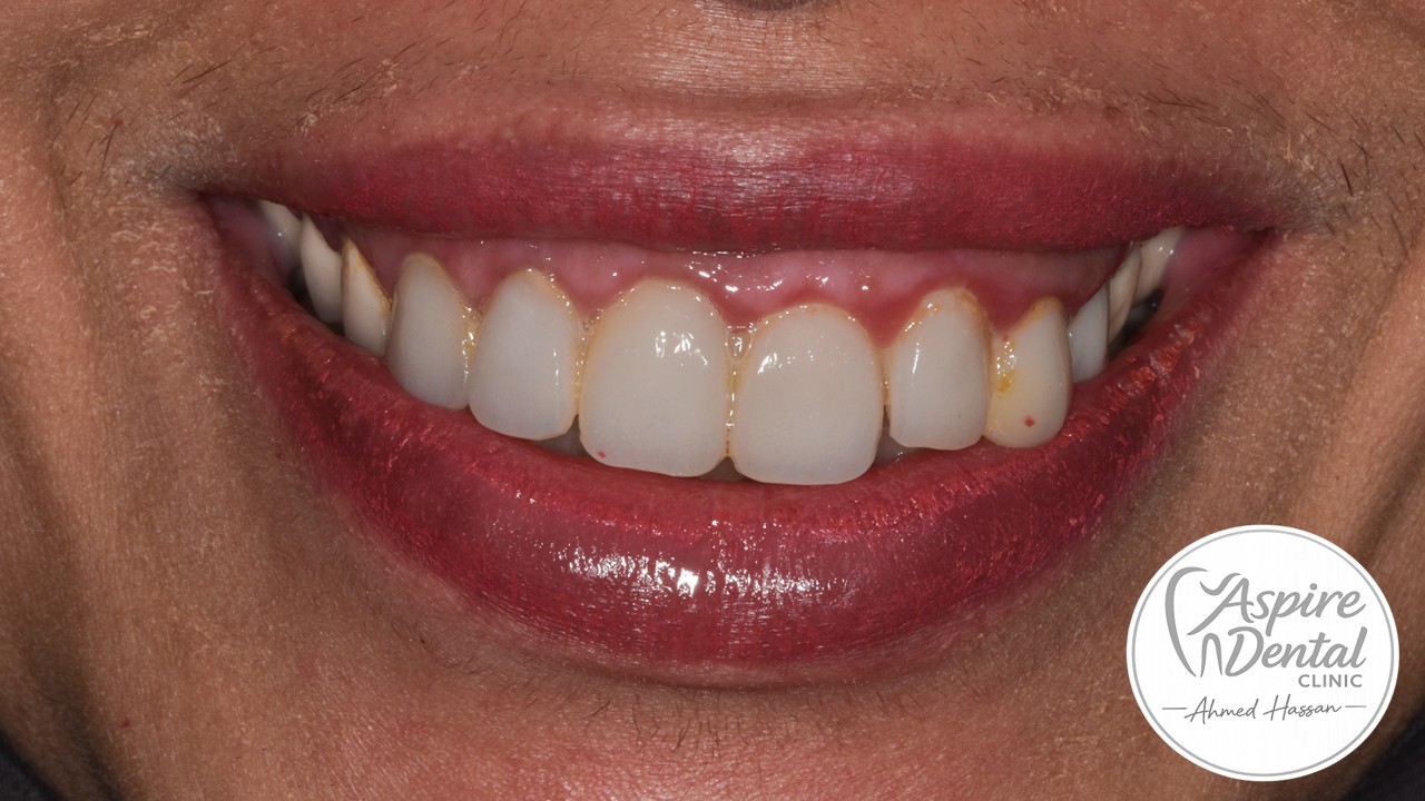 Before