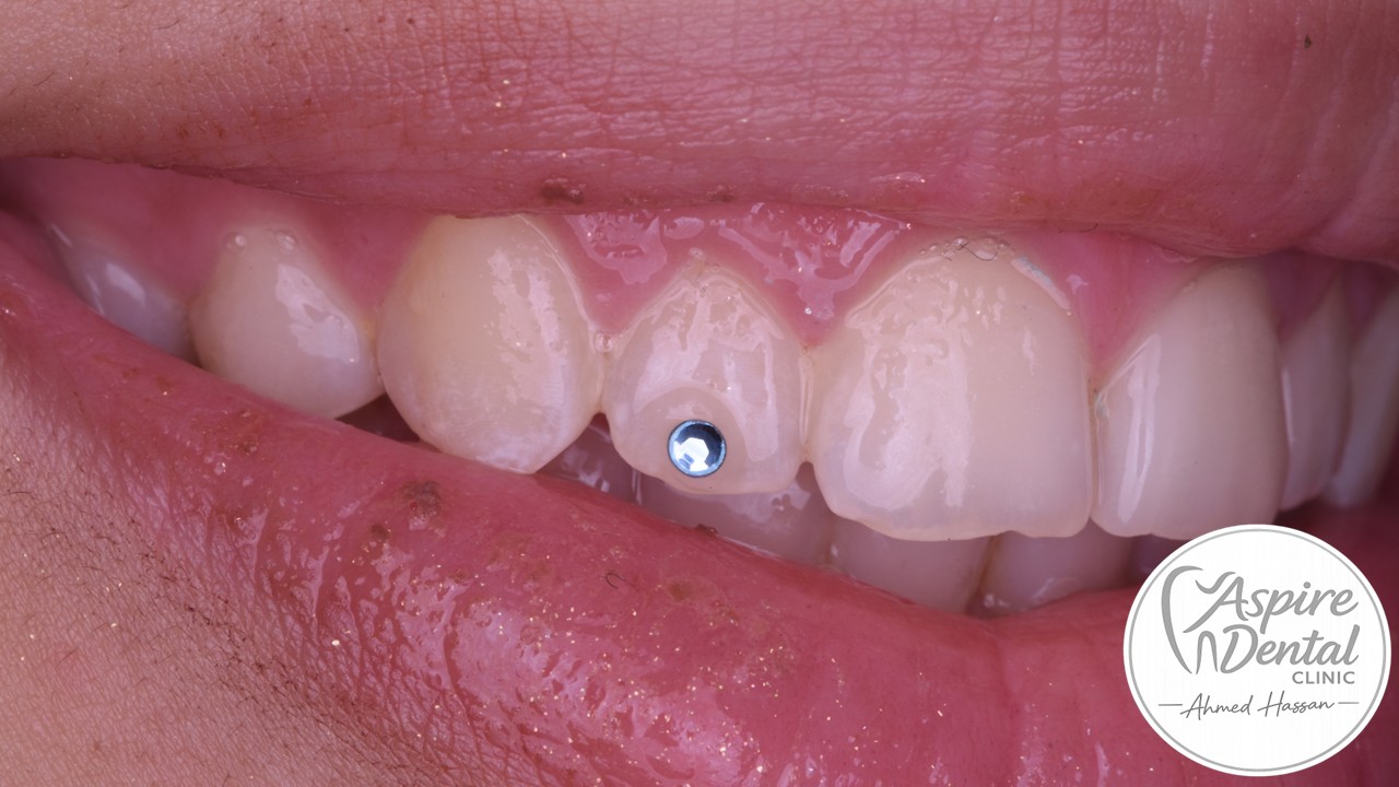 Tooth Gem